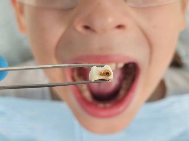 Best Emergency Dentist for Lost Fillings or Crowns in Heritage Lake, IL